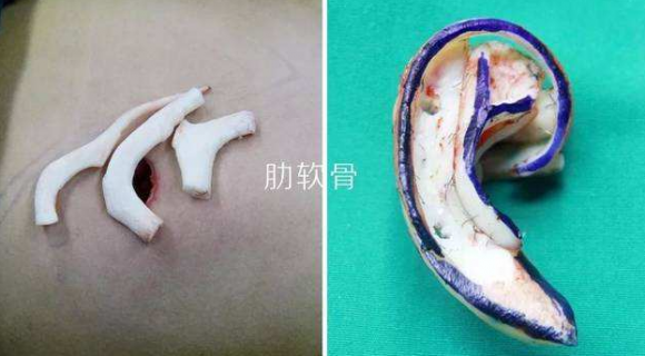 年级大了就不能做耳再造?生物支架突破年龄限制