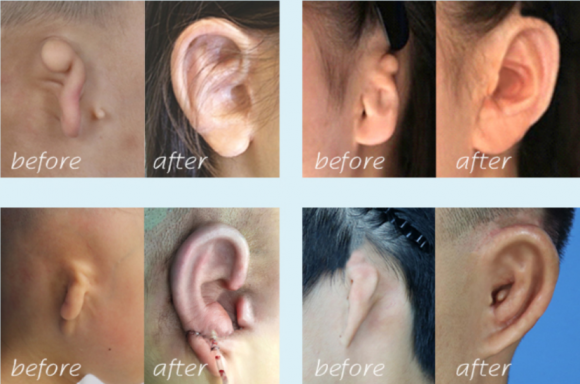 年级大了就不能做耳再造?生物支架突破年龄限制